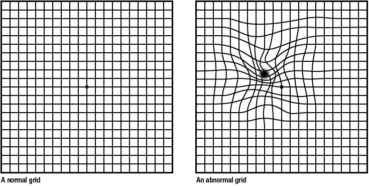 Age-related Macular Degeneration: Using The Amsler Grid — Costello Opticians
