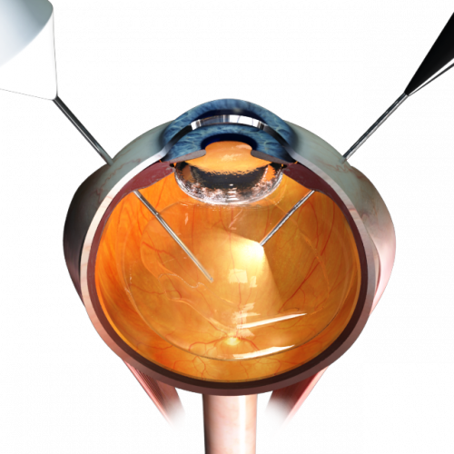 23. Vitrectomy