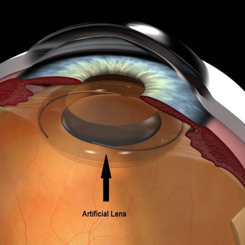 34. Artifical Lens Cat Sx