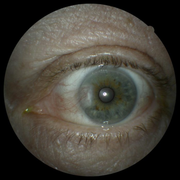 40. pterygium