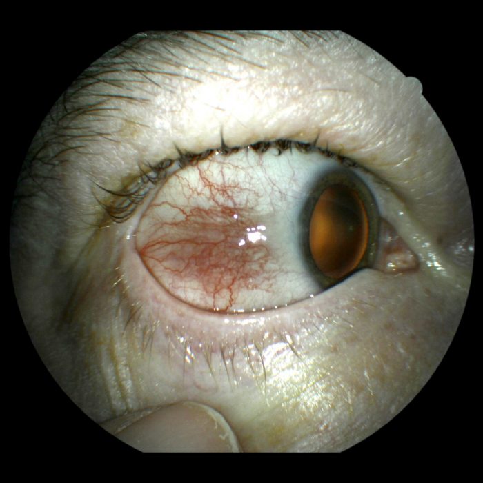 46. episcleritis