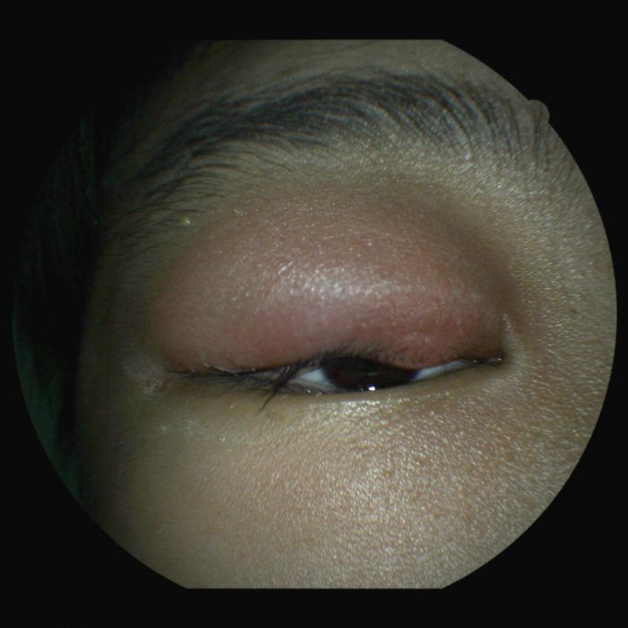 47. swollen eyelid from chalazion