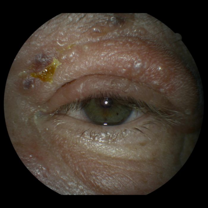 48. shingles near the eye