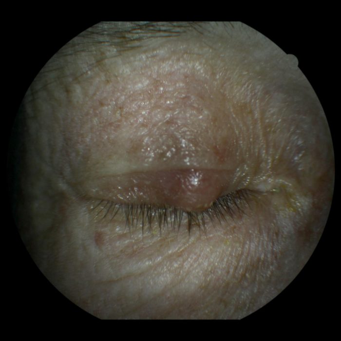 50. chalazion