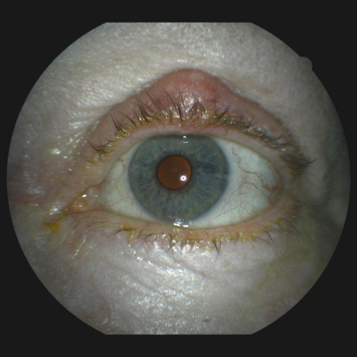 52. chalazion