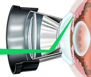 glaucoma-procedure