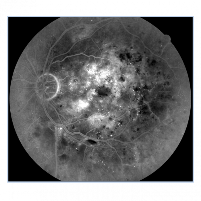 17. ischaemia with labels