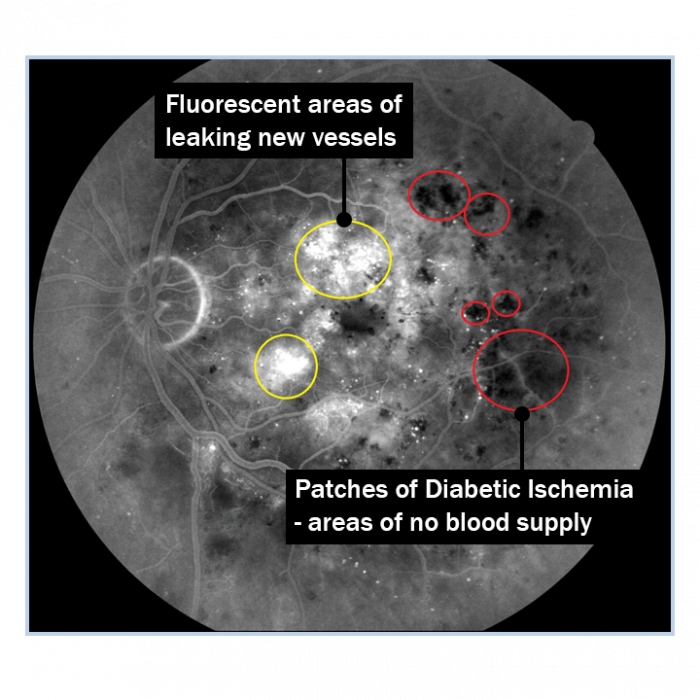 17a. ischaemia with labels