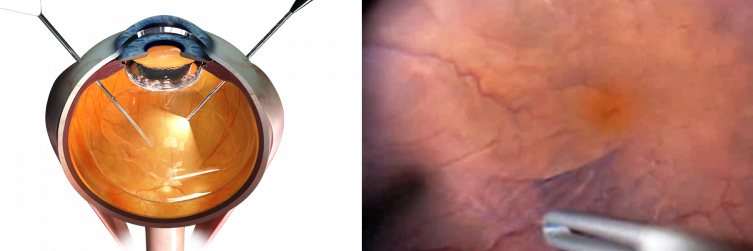 23. Vitrectomy_membrane_peel